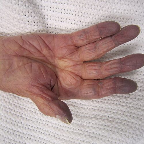 Akrozyanose Finger