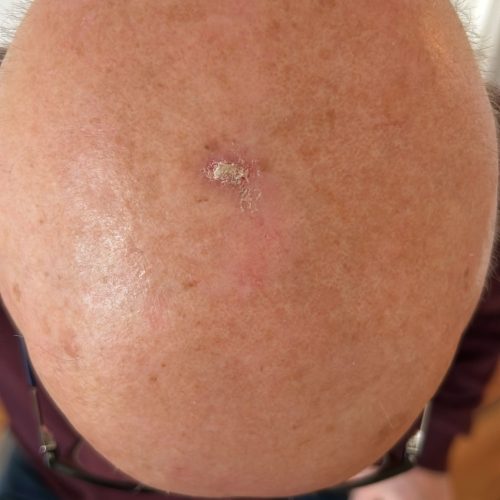 Aktinische Keratose