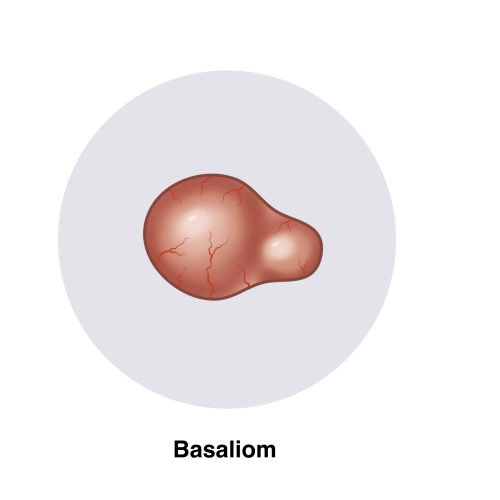 Basaliom, Illustration