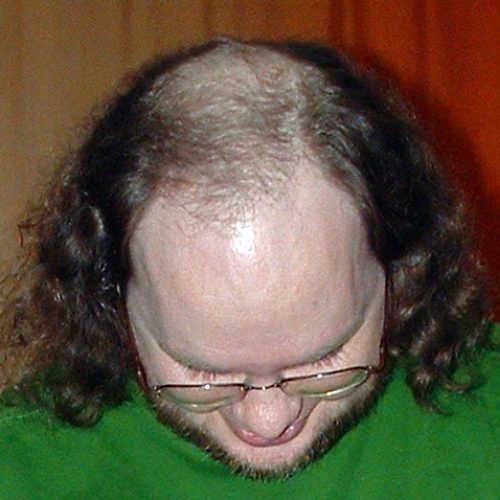 Erblicher Haarausfall am Hinterkopf und der Stirn