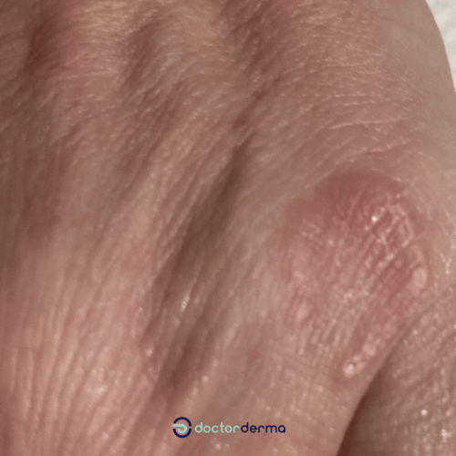 Granuloma anulare