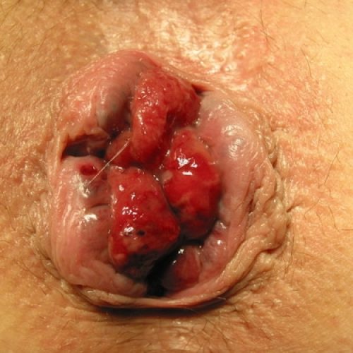 Hämorrhoiden