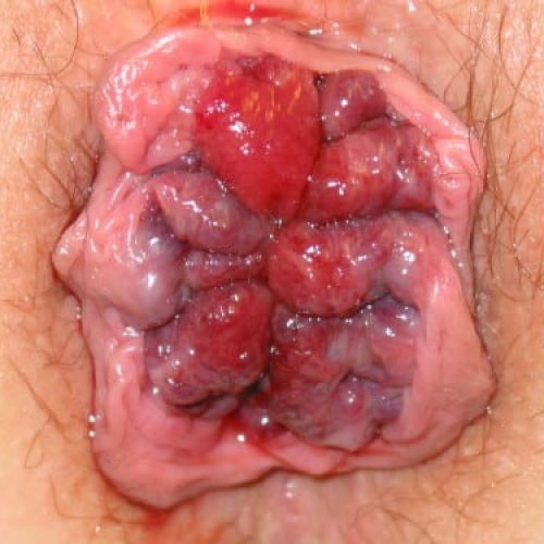Hämorrhoiden