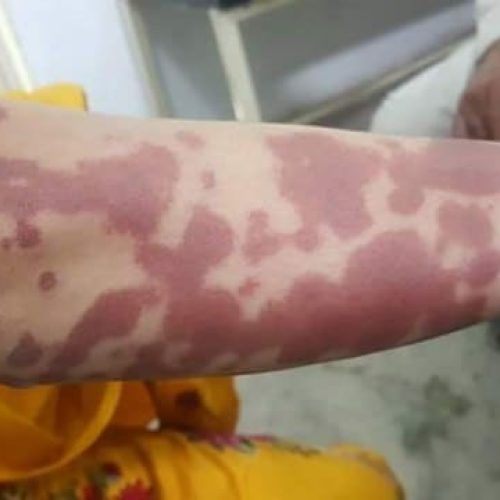 Purpura Schoenlein Henoch Flecken