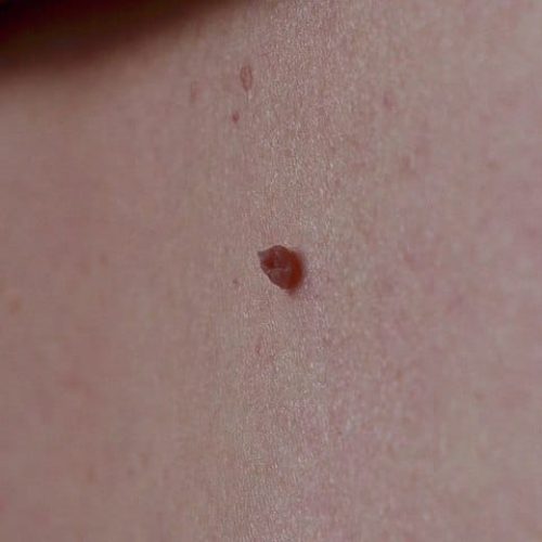 Weiches Fibrom