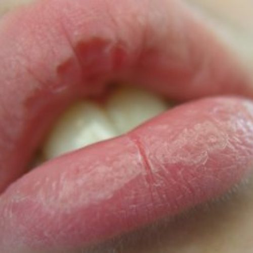 Frauenmund mit trockenen Zentral eingerissenen Lippen